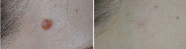 před a po odstranění papilomu laserem foto 2