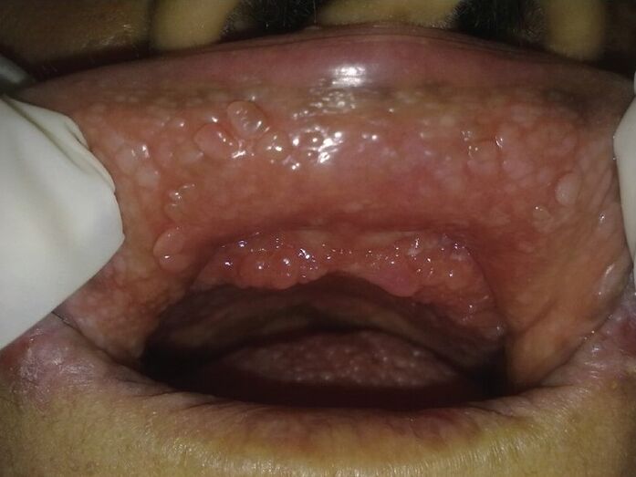 papilomy v ústech