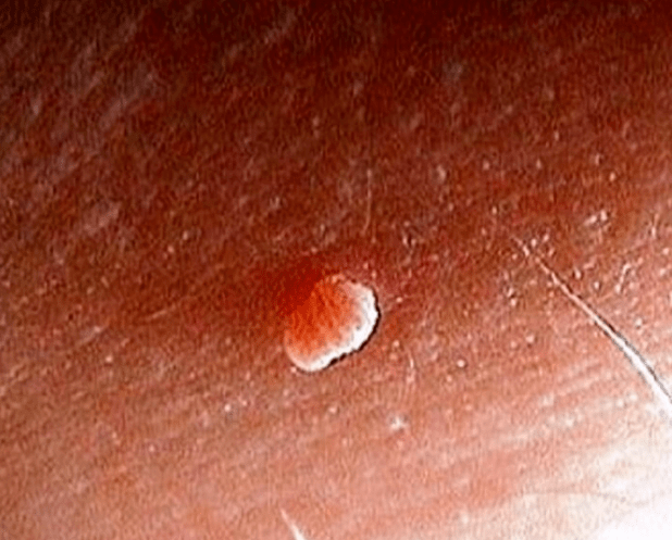 Papilloma na těle