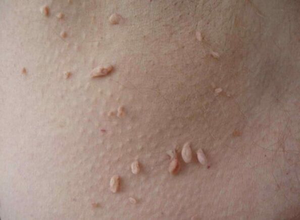 Acrochords on the Skin